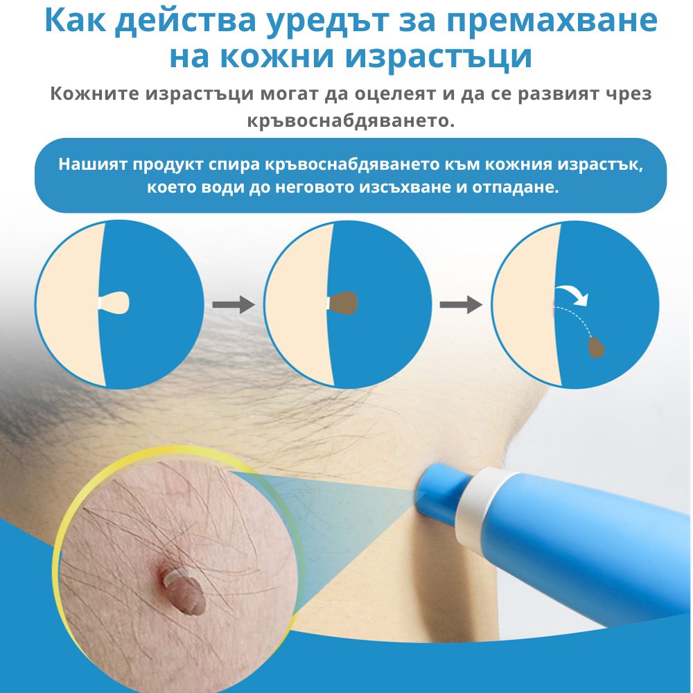 TagClean™ комплект за кожа – Премахнете кожните израстъци бързо и лесно.